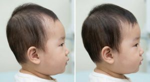 baby head shape correction before after